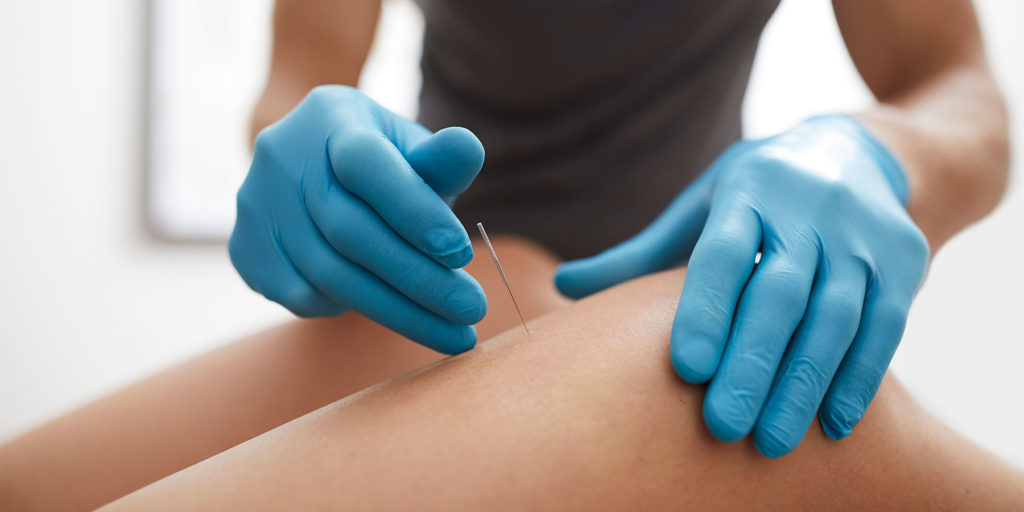 What Is Dry Needling? How Is It Different Than Acupuncture?