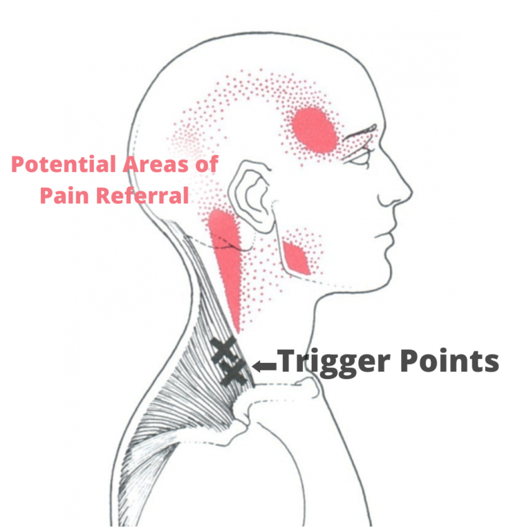 Dry Needling for Neck Pain - TruMotion Therapy | Chiropractor